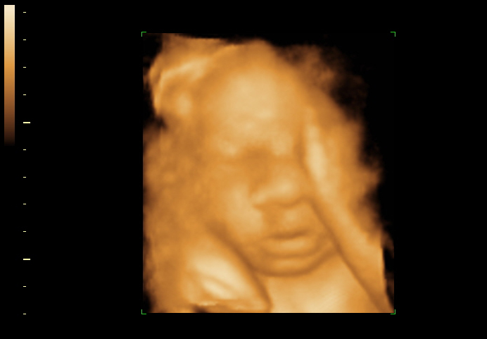 3D ultrasound image at 32 weeks